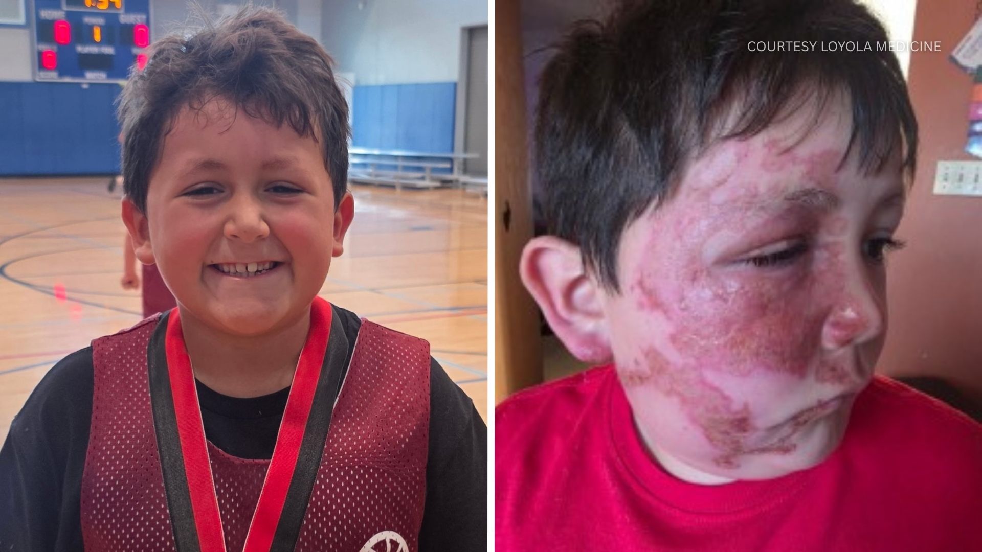Nine-year-old Caleb was left with severe burns after following a TikTok video of people microwaving a toy to make it more pliable.