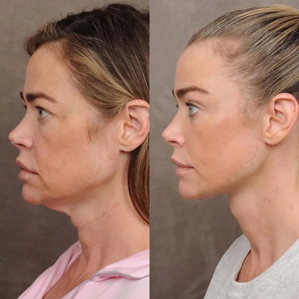 Denise Richards' facelift resultsCredit: Ben Talei, MD/Instagram