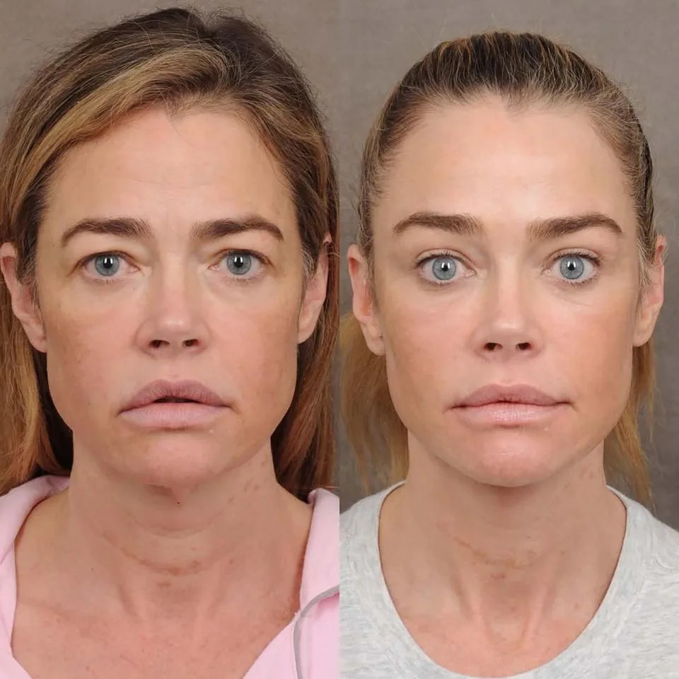 Denise Richards facelift resultsCredit: Ben Talei, MD/Instagram