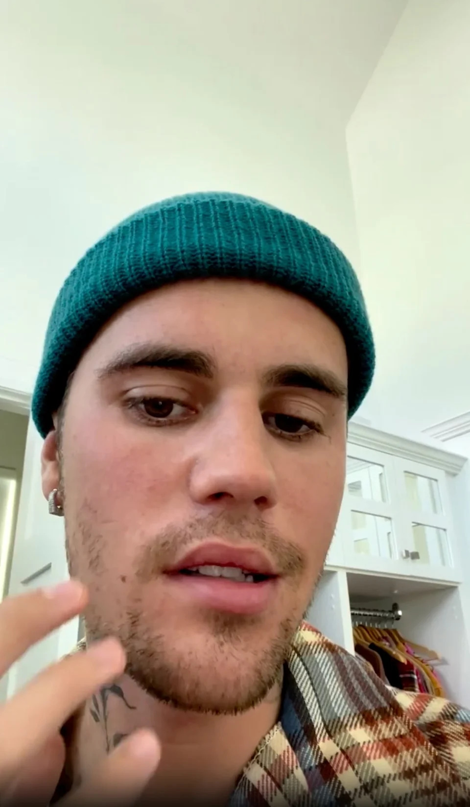 <p>Justin Bieber's Ramsay Hunt Syndrome</p>